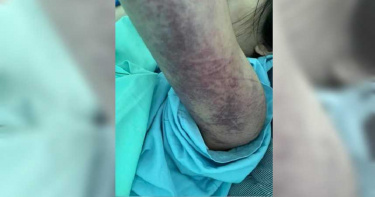 不爽被分手! 恐怖情人爆打正妹 小腿骨折背部全瘀青