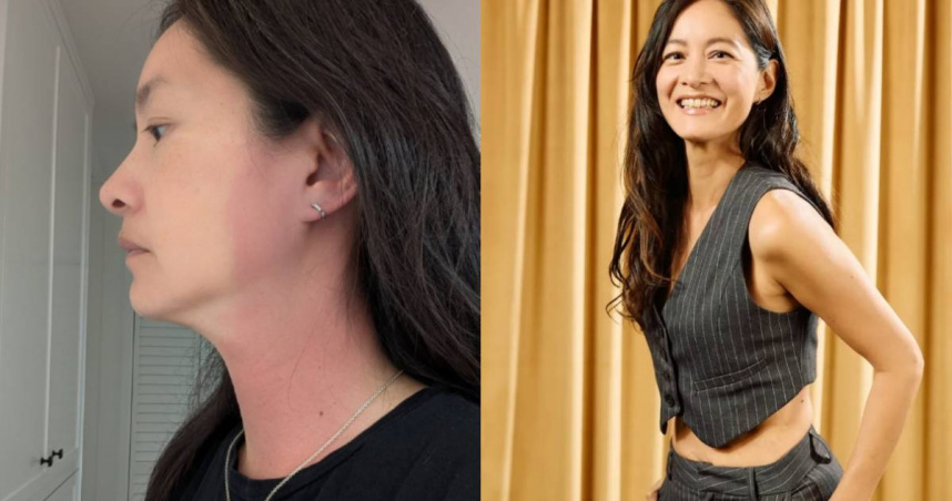 Janet的耳朵到胸口整片紅腫。（圖／翻攝自Instagram@janetagram）