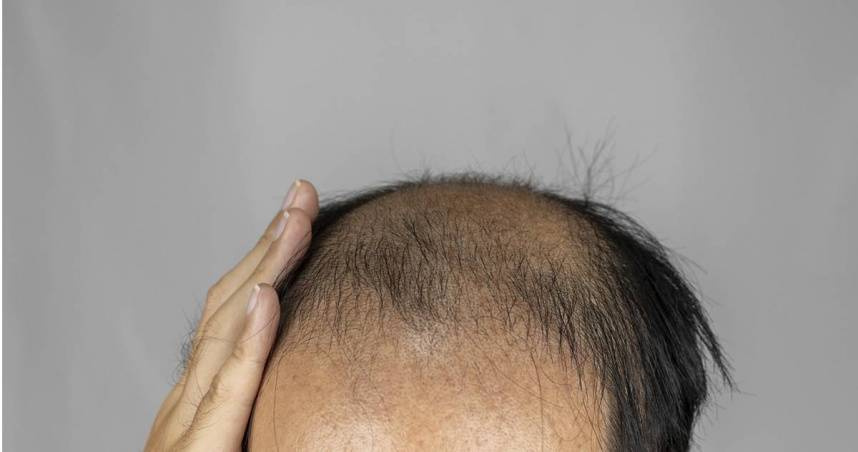 禿頭。（示意圖／photoAC）