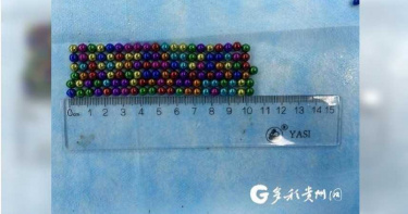 5歲男童誤吞123顆磁力珠 醫耗費4.5小時分割取出