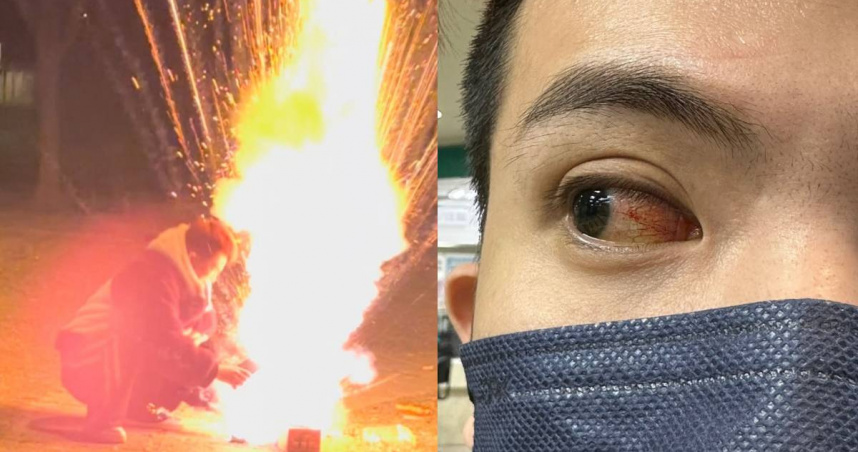 孫生放鞭炮時被炸傷眼睛。（圖／翻攝自Instagram／soon6669）