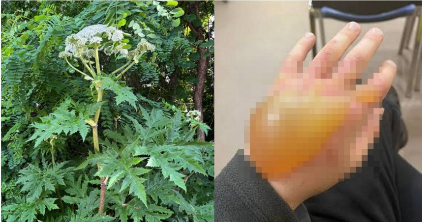 日本北海道大學校園出現有號稱世界第一猛毒植物「巨型霍格威德」（Giant Hogweed），有動植物寫生專家曾誤觸，手部起超巨大水泡，還留下疤痕。據悉，樹液不慎進入眼睛還可能失明。（圖／翻攝自X）
