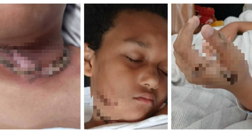 美國9歲男童亞什頓（Ashtyn Pitts）因平板充電線纏繞項鍊引發火災，導致臉部與頸部嚴重燒傷，目前已出院返校，但仍在心理復原中。（圖／翻攝自FB，Lauren Morrow）