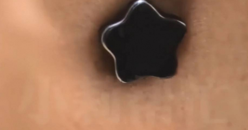 大陸一名李姓男子因臉受傷腫脹4天，意外腫脹的地方能吸住磁鐵，去治療時連醫師都驚呼從業20年第一次見；最後手術取出一顆小鋼珠，才揭曉為何他臉上為何能吸住磁鐵的原因。（圖／翻攝自《紅星新聞》）