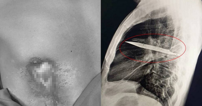 東非坦尚尼亞一名44歲男子右邊乳頭流膿，就醫才發現胸腔內有一把刀子，在體內長達至少8年時間。（圖／翻攝自X／Journal of Surgical Case Reports）