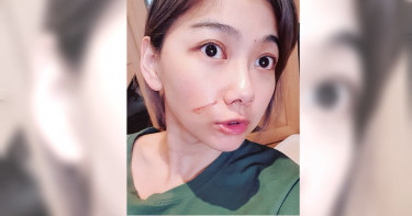 邵庭毀容自封「貓女刀疤」 毛小孩串供真兇抓不到