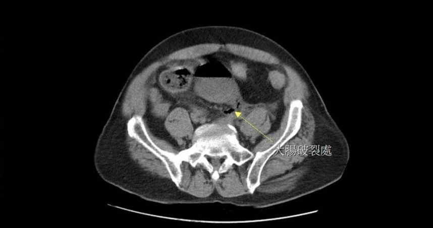 65歲男性病人因嚴重便祕而自行灌腸，導致直腸破洞（箭頭處），引發腹膜炎。（圖／翻攝畫面）