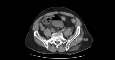 65歲男性病人因嚴重便祕而自行灌腸，導致直腸破洞（箭頭處），引發腹膜炎。（圖／翻攝畫面）