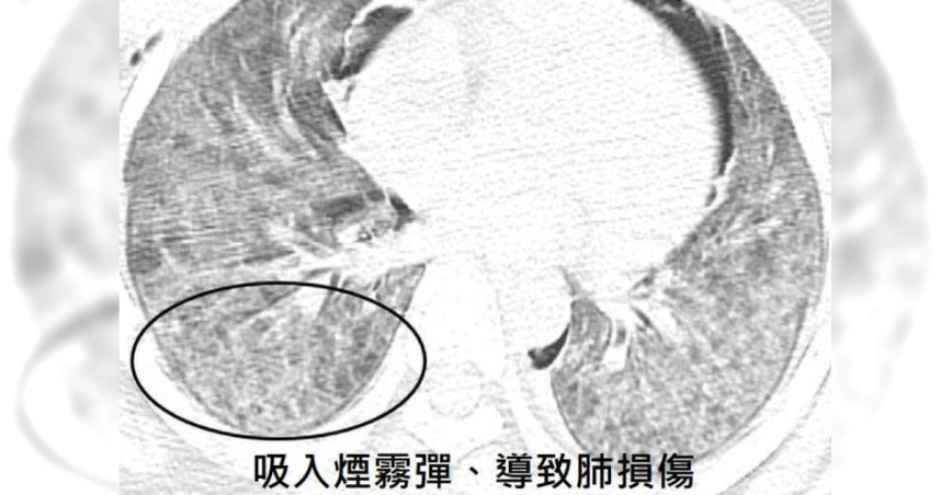 胸腔科名醫蘇一峰分享吸入煙霧彈燃燒後的煙霧，恐造成肺部和呼吸道損傷。（圖／翻攝自臉書／蘇一峰）