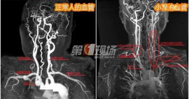 相思成疾!24歲女患「東方美女病」血管像70歲老人