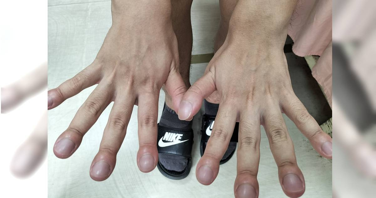 不是肺癌!年輕男子驚見「杵狀指」 醫揭:無法痊癒 | 生活 | CTWANT