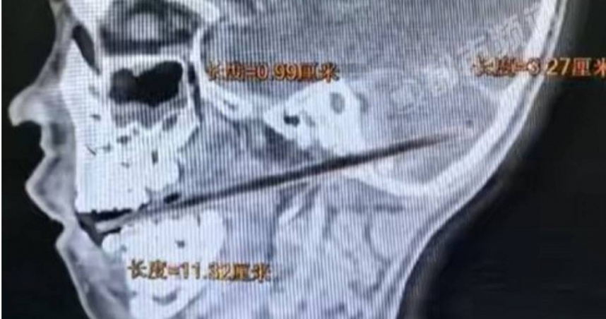 中國廣東一名6歲男童，日前在吃手工麥芽糖時不慎摔倒，插著麥芽糖的竹籤，直接從男童口腔刺進貫穿顱底刺入小腦。（圖／抖音）