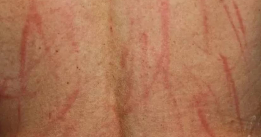 外科醫師陳榮堅分享一起案例指出，肝指數和黃疸指數高會引起皮膚搔癢，病患就會在不自覺抓癢時留下抓痕。（示意圖／翻攝自KlikDokter Instagram）