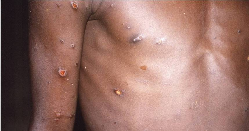 疾病管制署今（25日）公布國內11月新增7例M痘確定病例。（示意圖／達志／美聯社）