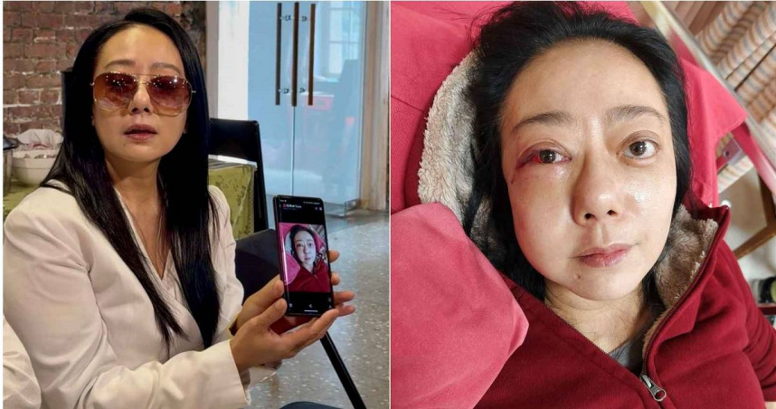 高慧君「斷片式昏倒」！臉部朝下重摔臉骨骨折　驚悚傷勢曝光