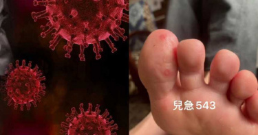 新發現!50歲以下 輕症或無症狀患者驚傳腦中風