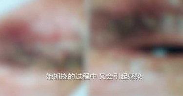眼睛好癢強光一照!睫毛根部「密麻蟲子亂竄」 醫:公共浴室洗澡也要注意