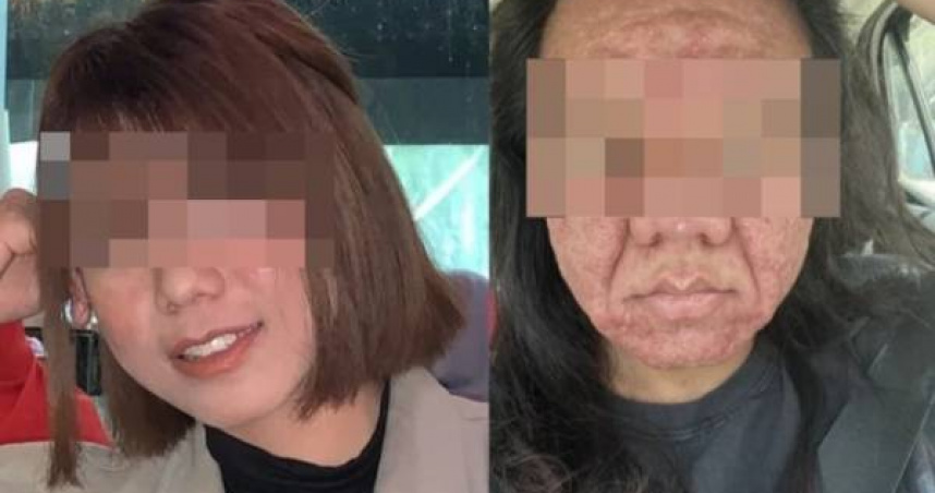 馬來西亞一名女子懷孕後，臉上突然長滿痘痘和細紋，還出現臉部皮膚鬆弛的狀況，讓她崩潰直呼「自己像是變成另一個人」。（圖／翻攝自mStar）