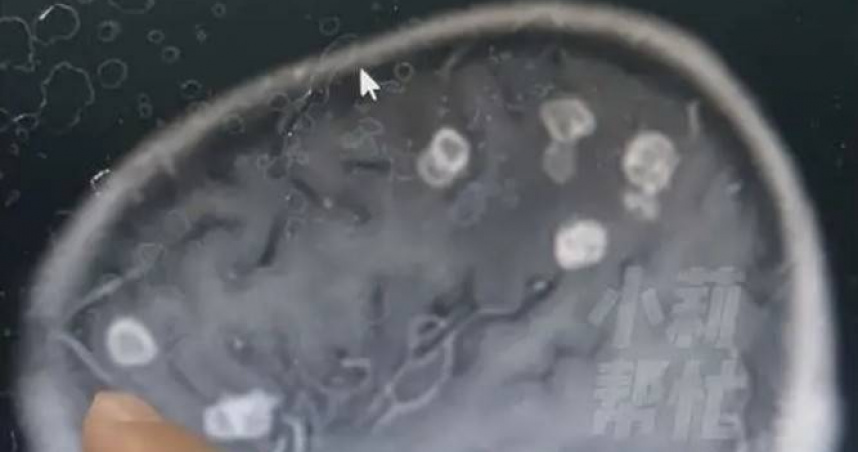 大陸河南省鄭州市一名6歲女童近日持續高燒長達17天。經送醫檢查後，醫師赫然發現其腦部遭真菌嚴重侵蝕。（圖／翻攝自河南電視台）
