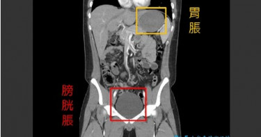 為500元送急診!高中生挑戰「無敵麻辣麵」劇烈腹痛尿不出