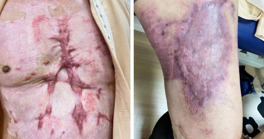 陽光社會福利基金會指出，瓦斯使用不甚將造成生命財產重大損失，基金會2022年至2024年開案服務瓦斯燒傷倖存者就有129位，年齡最小甚至只有4歲，呼籲政府強化偵測、遮斷、教育，降低瓦斯意外發生風險。（圖／陽光基金會提供）