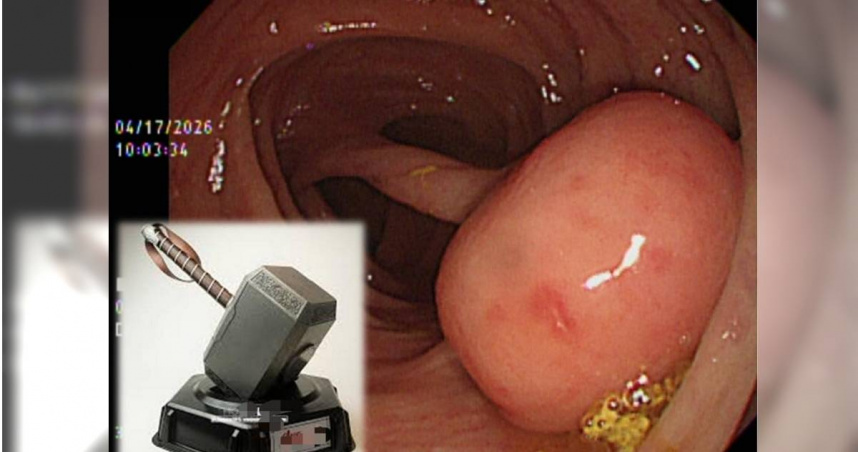 肝膽腸胃內科醫師方冠傑在個人粉專分享，一名患者大腸的息肉巨大且形狀宛如「雷神之鎚」。（圖／翻攝自臉書／方冠傑醫師）