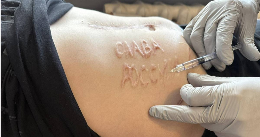 此前一名獲釋的烏克蘭軍人在俄羅斯戰俘營中被迫在身體上烙下「榮耀歸於俄羅斯」的羞辱字樣，近日有醫療團隊對他伸出援手，要移除這道殘酷的疤痕，還給他心靈的自由。（圖／翻攝FB／Максим Туркевич）