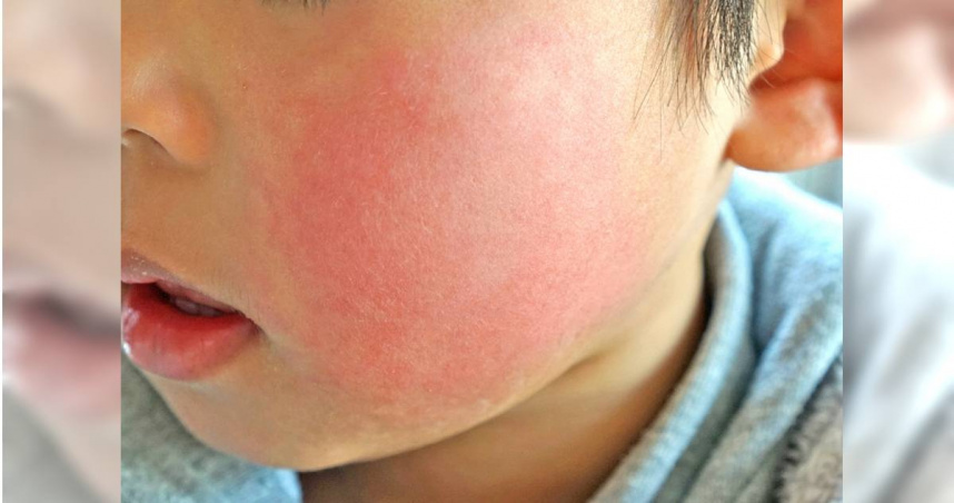 「蘋果病」好發於5至15歲兒童。圖僅示意，與當事人無關。（示意圖／photoAC）