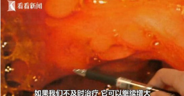 男腸胃長滿「60顆肉色珍珠」 醫揭「關鍵原因」現代人都中槍!