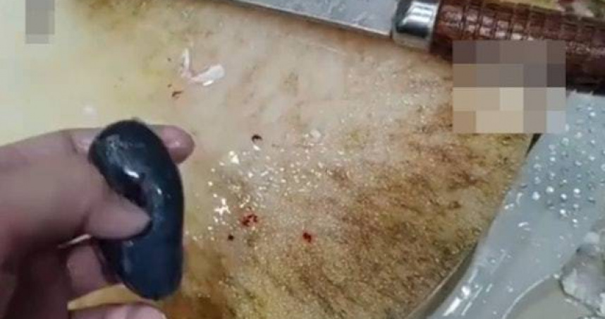 大陸一名女子聽信偏方生吃魚膽結果中毒，送急診、住進ICU治療才逃過死劫。（圖／翻攝自微博／荔枝新聞）