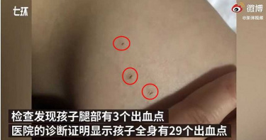 幼兒園放學回家…母驚見女兒身上29個詭異針孔 3歲女童:老師幫我打針