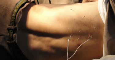 55歲男腰痛「自行針灸」!10公分長針斷體內游走 醫驚曝:恐致命
