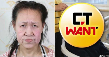 15歲少女罹罕病「滿臉鬆弛如老婦」 整型後變這樣!