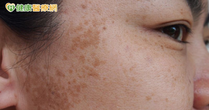 雷射不成反增黑斑！53歲女確診罹患「皮膚癌」