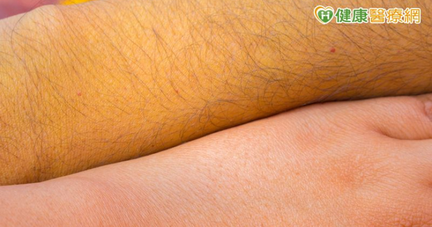 體內膽紅素過多　引發黃疸症狀