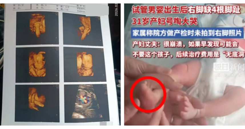 試管男嬰右足缺4趾，家屬質疑產檢未示警。（圖／翻攝自封面新聞）