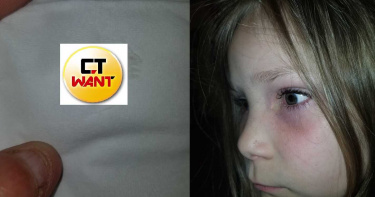 我的左眼遇到蟲!6 歲女童慘被「爬眼球」9hrs 掀眼皮還流出黃膿