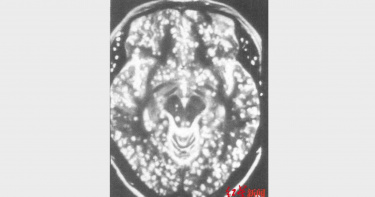 頭痛3個月!40歲男「一習慣」腦內長滿蟲 醫搖頭:像一張芝麻餅