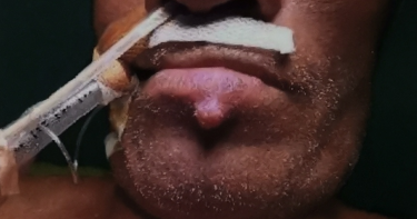 嚇人!!阿伯下唇冒痘不為意 竟是癌症轉移