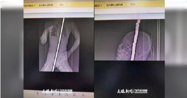 男童墜樓遭鋼筋刺穿 「心臟收縮」逃過死神魔掌