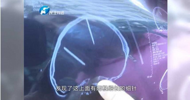 車禍住院照X光…腦中竟「藏2根針」 女震驚:怎麼進去的?