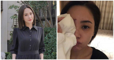 阿嬌傷後自拍!影片曝光好驚訝 大嘆「不重要」:活在當下就好