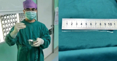 廣東一名男子的大腦裡卡了一隻10多公分長、還在蠕動的寄生蟲。(圖/翻攝自微博/廣州日報)