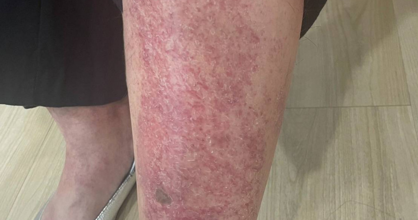 天氣冷易使皮膚過於乾燥，可能導致脫屑、泛紅，嚴重還有出現瘙癢或龜裂。（圖／黃靖富提供）