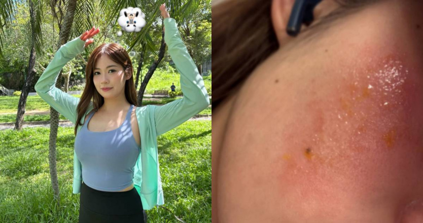 黃婧靈日前罹患「玫瑰痤瘡」。（圖／翻攝自黃婧靈IG）