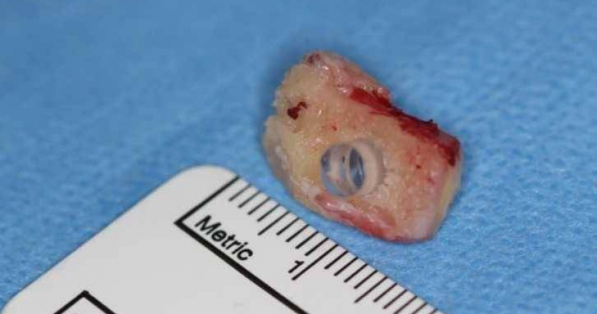 骨齒角膜義眼植入術（osteo-odonto keratoprosthesis, OOKP）。（圖／翻攝自FB @Dentistry）