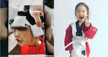 4歲妹嘴唇慘被剪成「鋸齒狀」 繼母瞎扯:她自己打自己