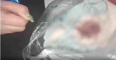 女老師狠踹!7歲男童「下體被踢爆」撕裂2cm超腫 血水一直流