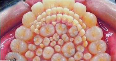 「300顆牙齒」塞爆!菲國男童罹罕病…開刀一次狂拔40顆牙