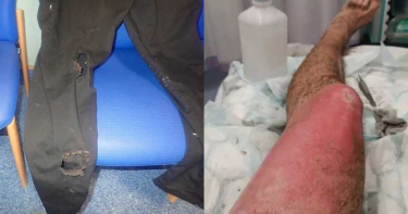 「電子煙+鑰匙」摩擦引爆炸 大腿三度灼傷…毛被燒個精光